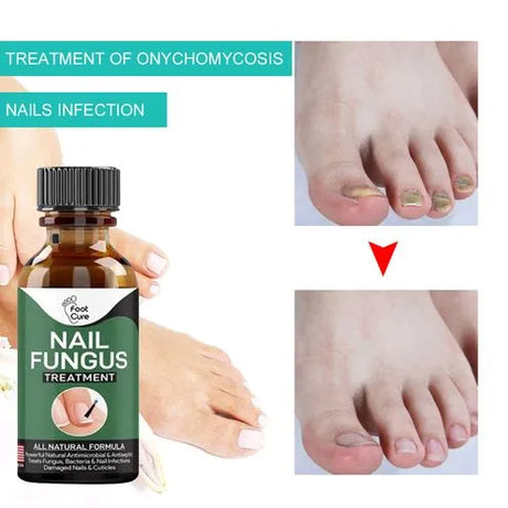 Nail Fungus Treatment Serum